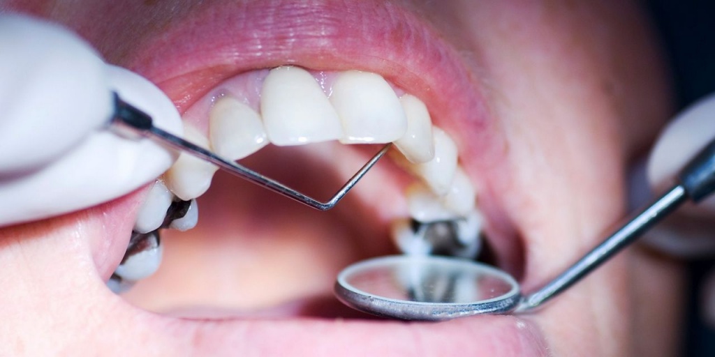 Методы лечения кариеса - детская стоматология Рудента
