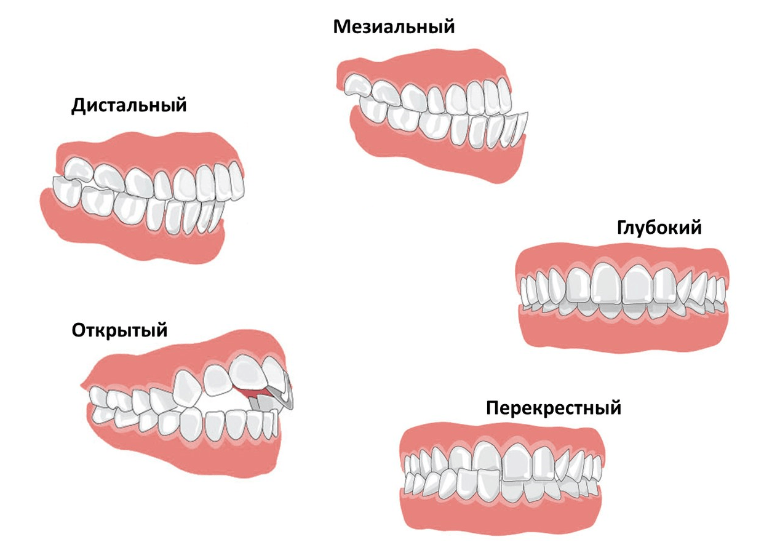Выровнять прикус зубов Импланты Bicon Томск Селькупская