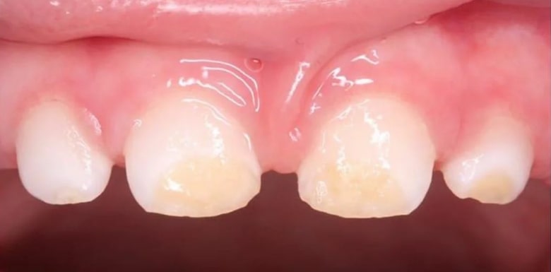 Причины неправильного порядка прорезывания зубов