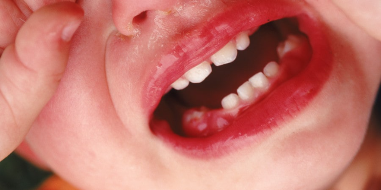 Виды стоматита у ребенка: симптомы, описание, рекомендации по лечению